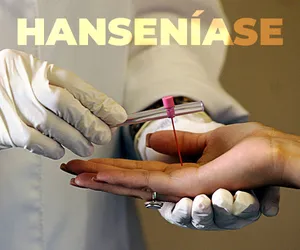 Hanseníase: como a análise espacial e temporal auxilia na vigilância em saúde